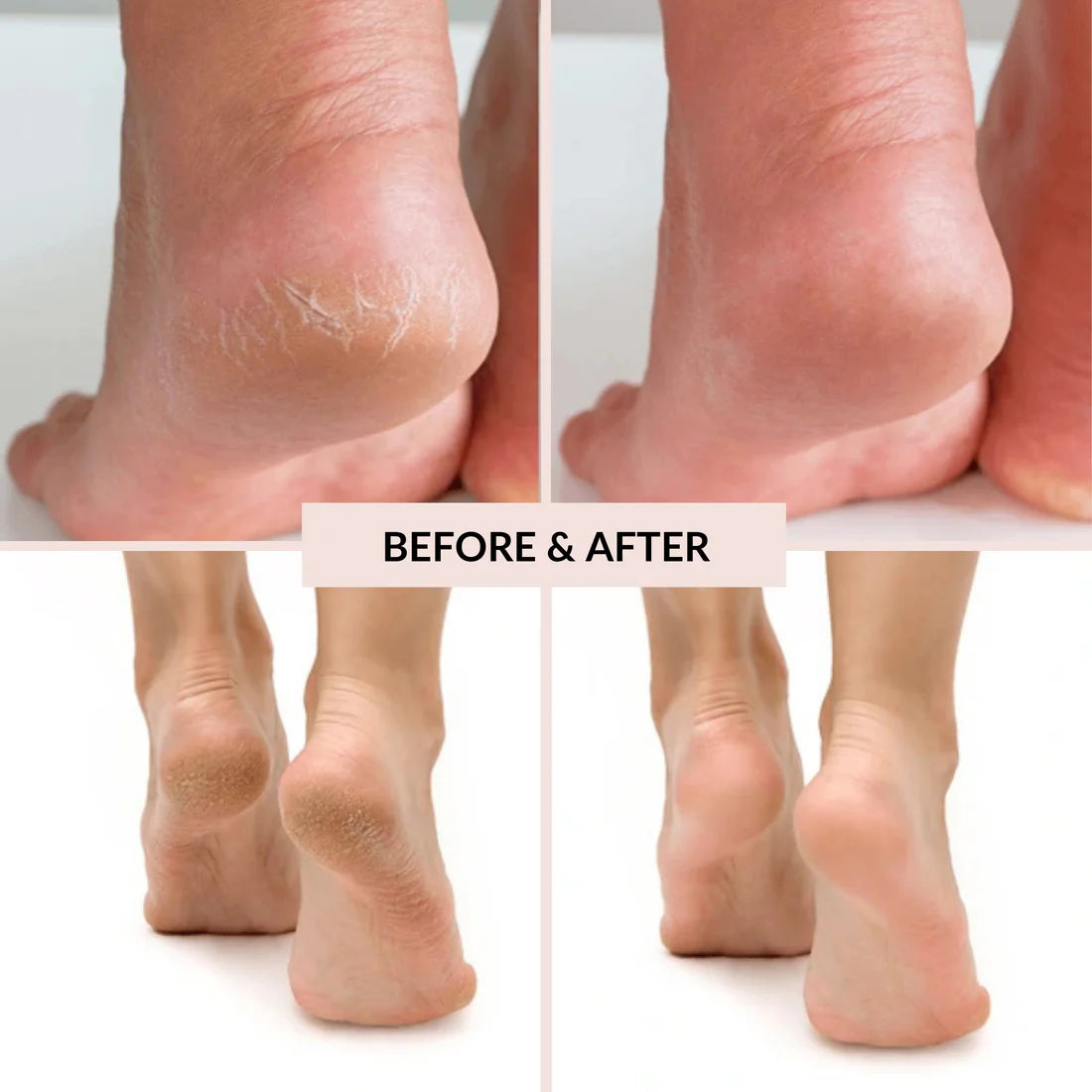 Homiigo™ Electric Callus Remover