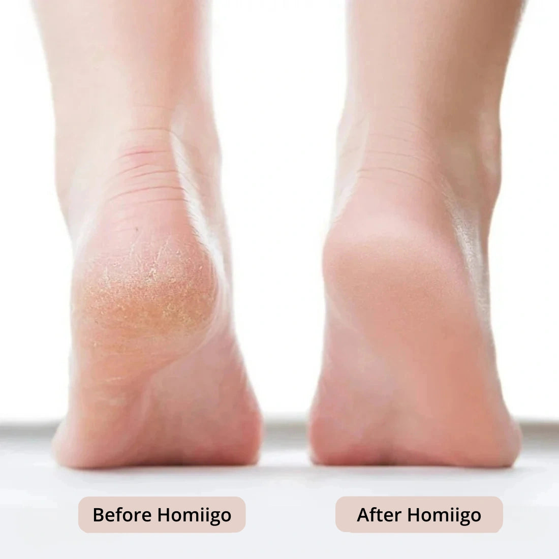 Homiigo™ Electric Callus Remover